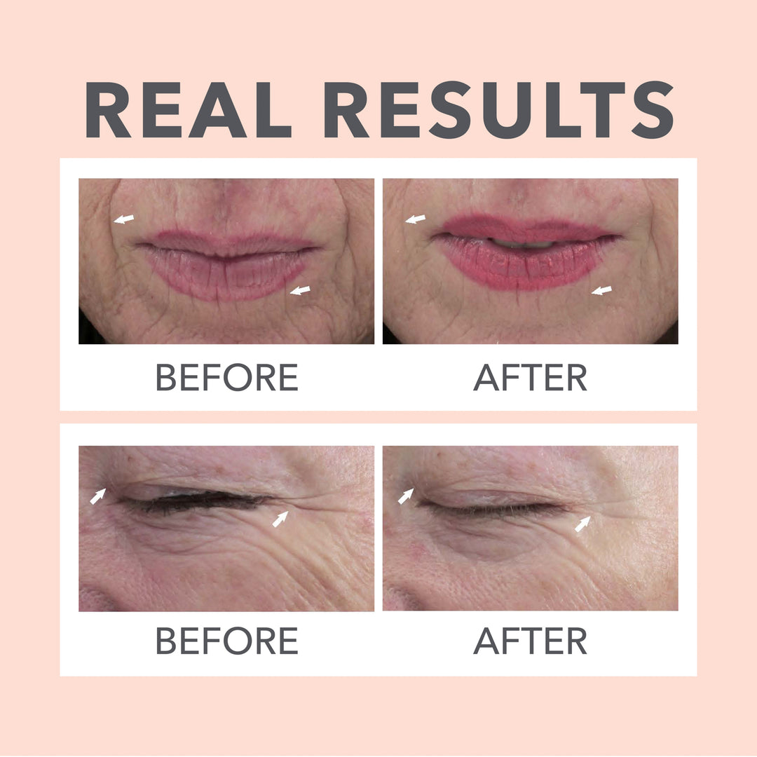 ★NEEDLE SERUM 3本セット Amazon.co.jp: フラクショナルCC ニードルセラムC おまけ付きセット